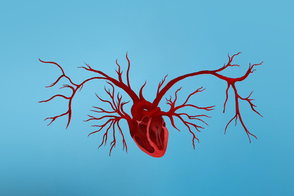 coronary-artery-disease