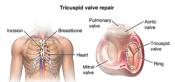 Tricuspid-valv-repair