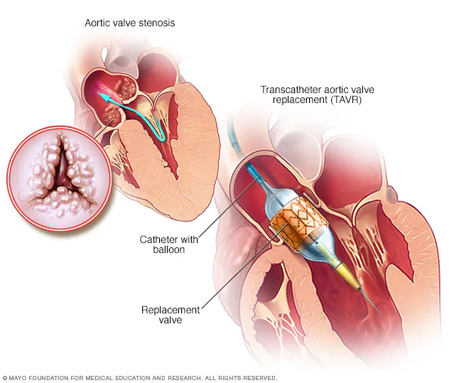 aortic-valve-replacement