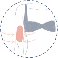 arm_lift_surgery