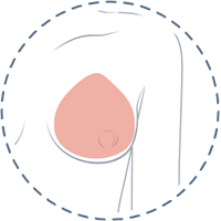 breast_implant_surgery