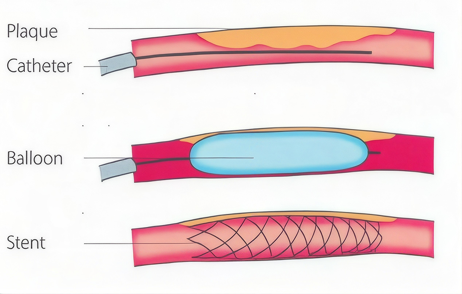 Angioplasty and stenting illustration