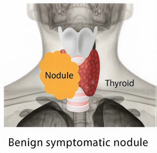 Thyroid nodule illustration