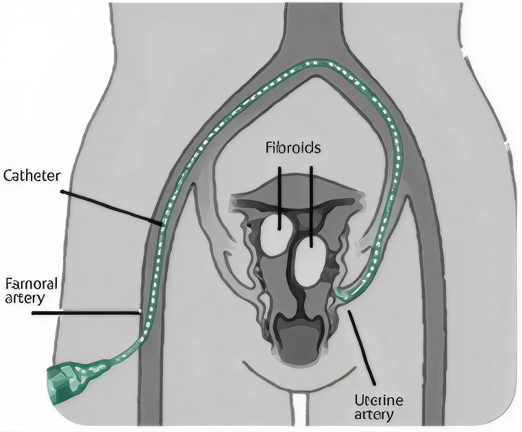 Uterine artery embolisation illustration